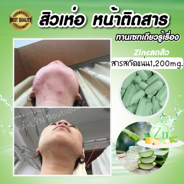 ☘️Zinc Plus Alovera วิตามินลดสิวหน้าใสเรียบเนียน ผิวเงาชุ่มชื้น - Image 4