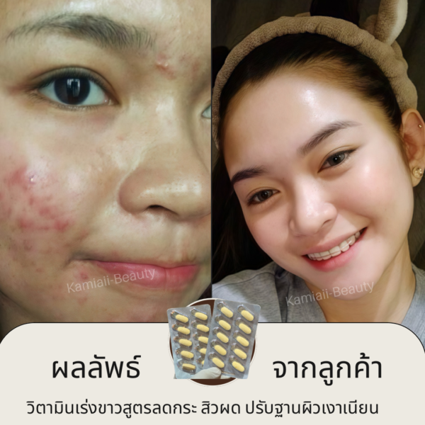 💥1แถม1 จำกัด🔺 วิตามินเร่งขาวสูตรหน้าเงา ลดกระ สิว ฝ้า เร่งดูดซึม Bira C อย.ไทย - Image 5